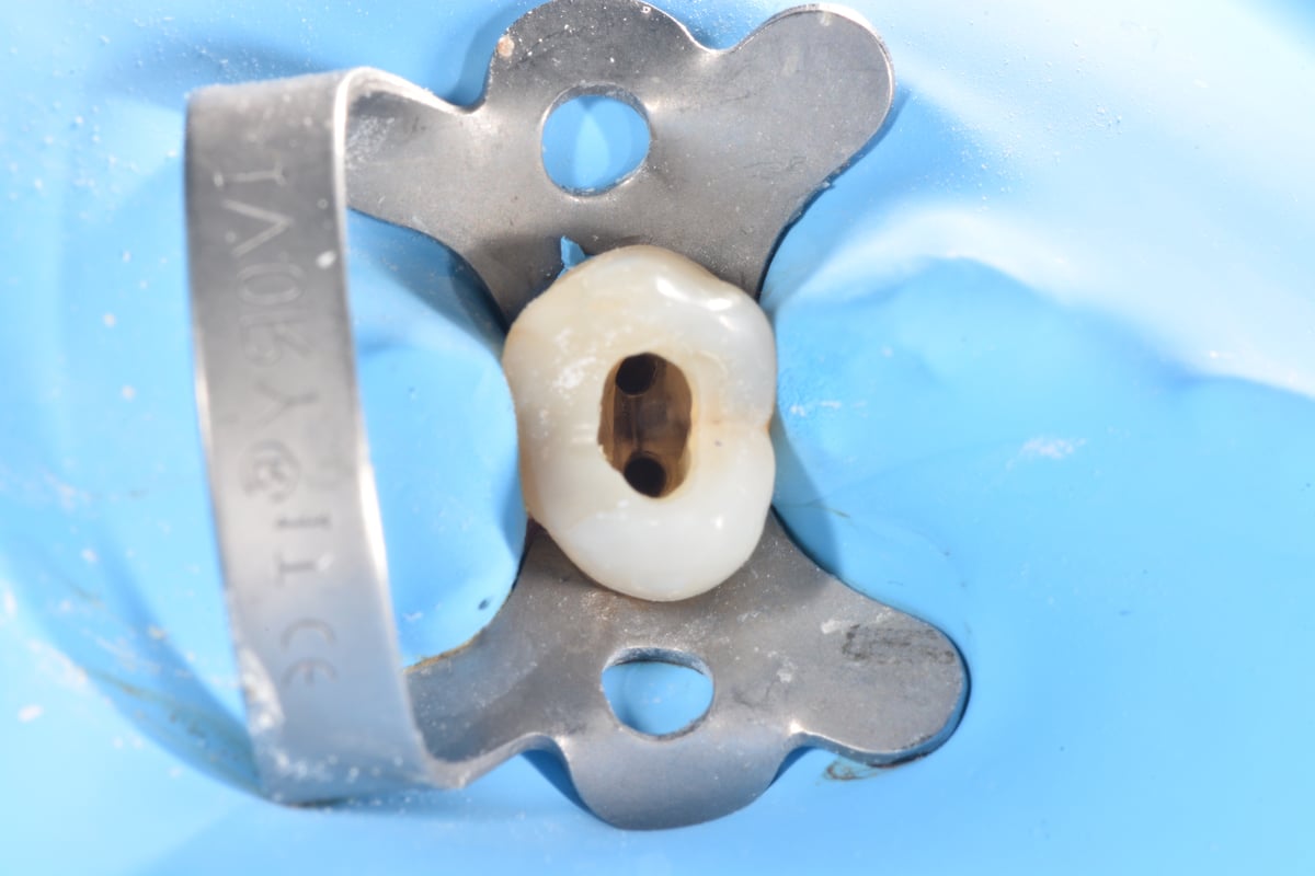 La diga dentale in odontoiatria | Clinica Marchetti La diga dentale in odontoiatria | Clinica Marchetti